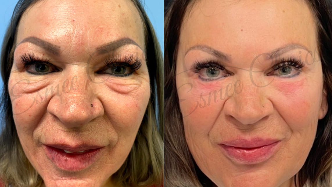 Before and After img